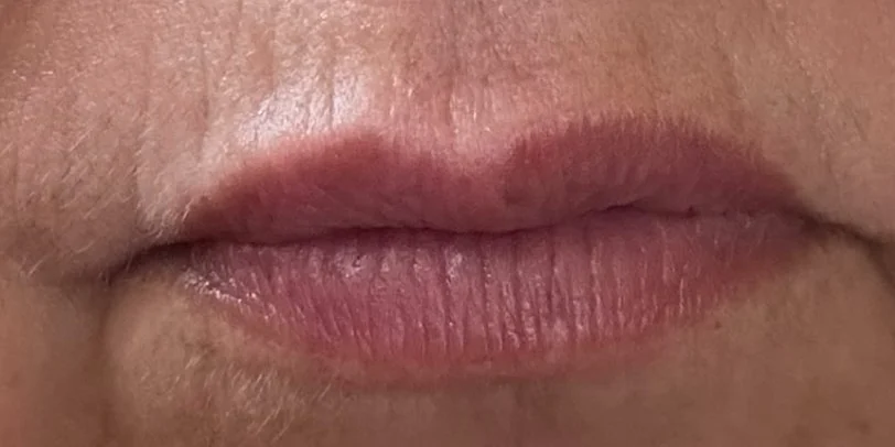 Lips after one week of daily PLUNA use