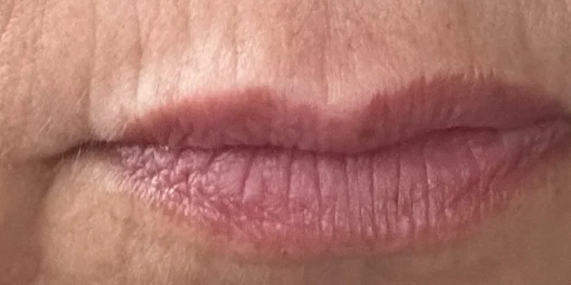 Lips before PLUNA, day 0