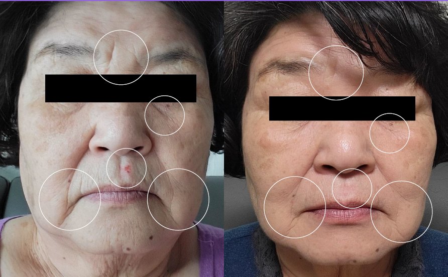 PLUNA before and after, mature skin, two weeks of daily at-home use